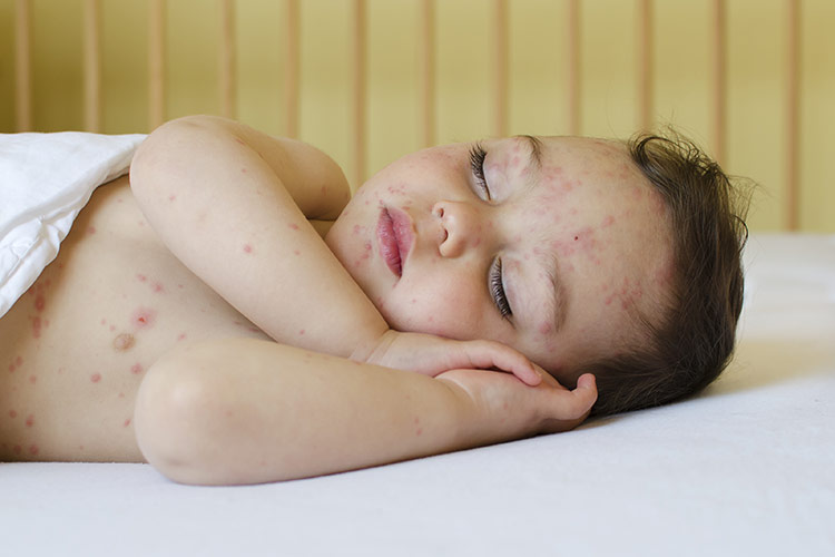 Dětské kožní nemoci | Foto: Shutterstock