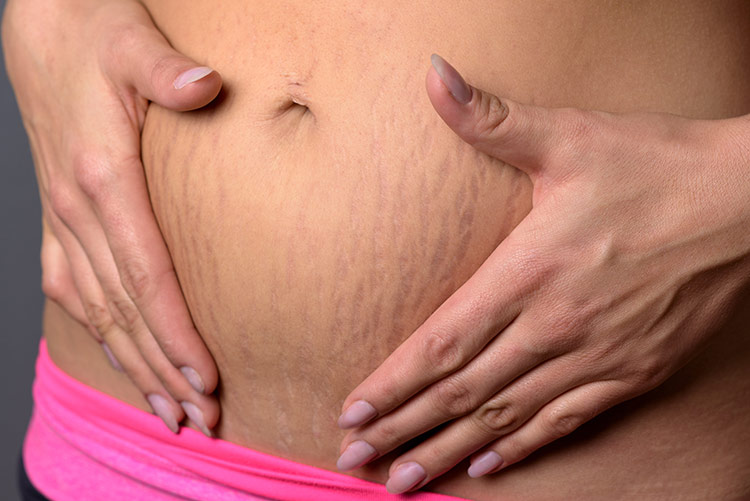 Strie v těhotenství | Foto: Shutterstock