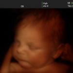 Těhotenský 3D ultrazvuk