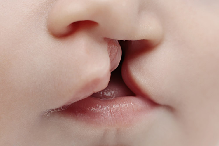 Rozštěp rtů u dětí | Foto: Shutterstock
